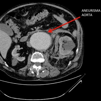 imagen de aneurisma de aorta 1