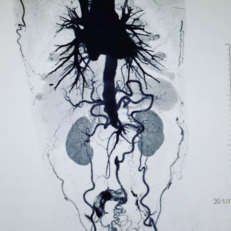 Síndrome de Leriche Clínica Medivas Madrid