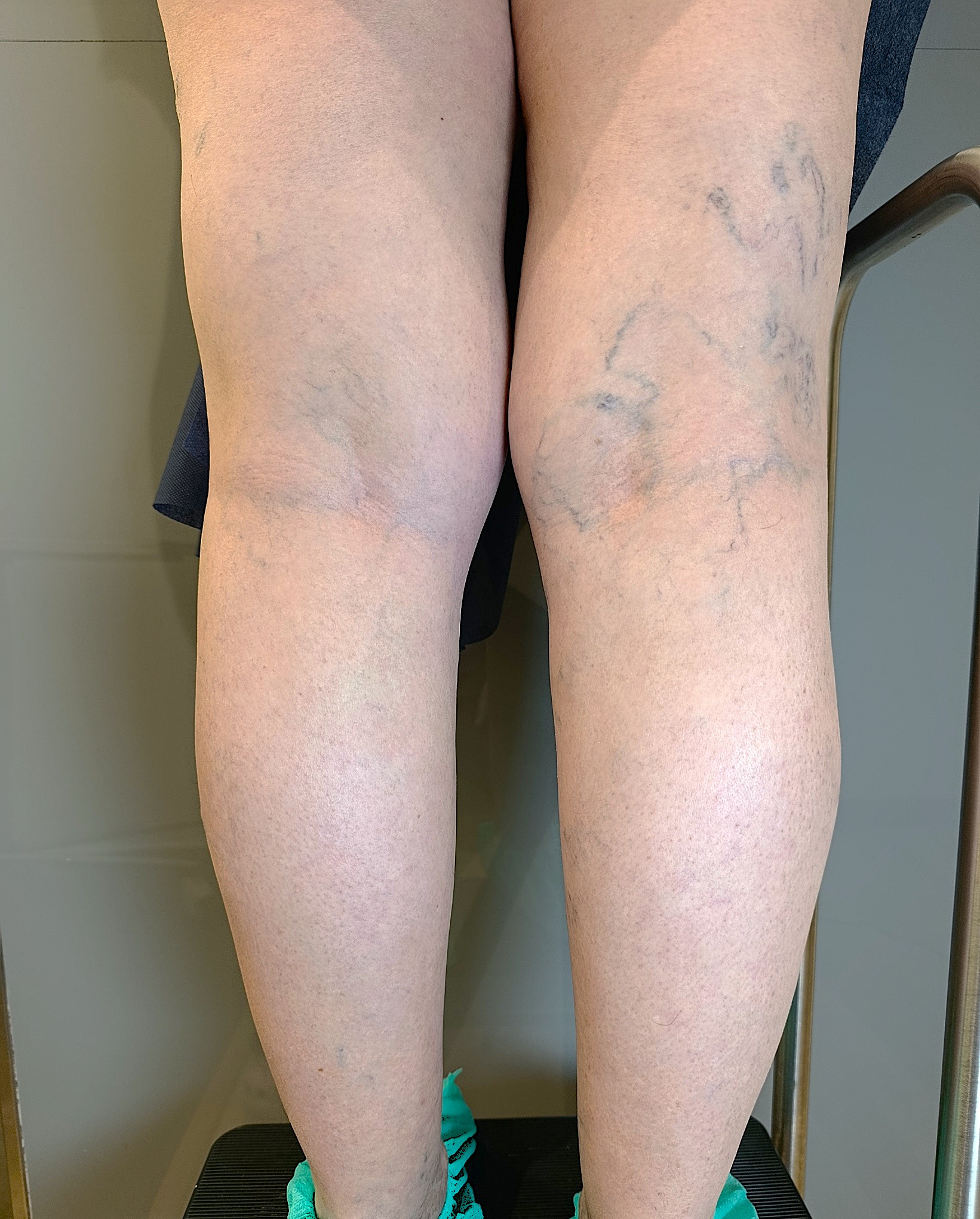 Tratamiento de varices reticulares en Madrid