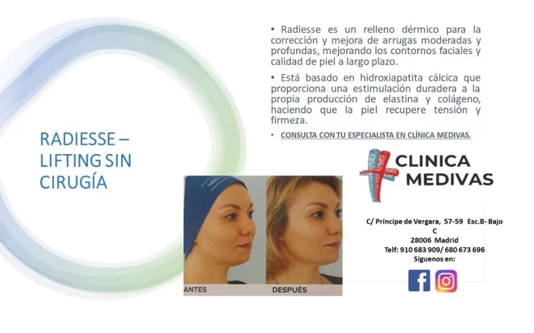 Radiesse Lifting sin Cirugía