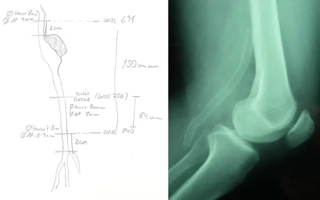 Importancia de la medición en el treatment endovascular de los aneurismas poplíteos. | Clínica Medivás Madrid medición en el tratamiento endovascular de los aneurismas poplíteos