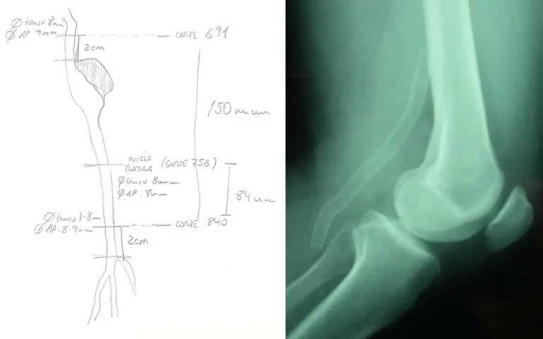Importancia de la medición en el treatment endovascular de los aneurismas poplíteos. | Clínica Medivás Madrid medición en el tratamiento endovascular de los aneurismas poplíteos