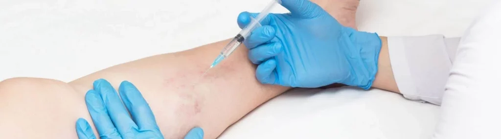 tratamiento de varices en madrid