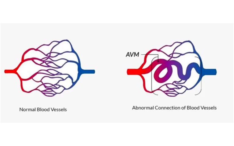 Malformación arteriovenosa