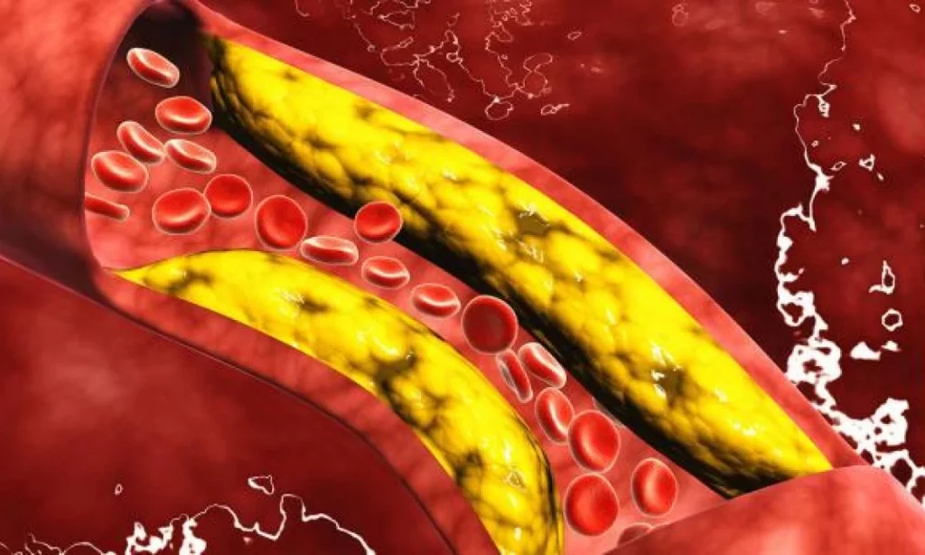 Enfermedad Cerebrovascular