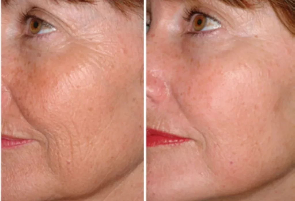 "Three for me", treatment láser facial. | Clínica Medivás Madrid Imagen informativa de Clínica Medivás Madrid