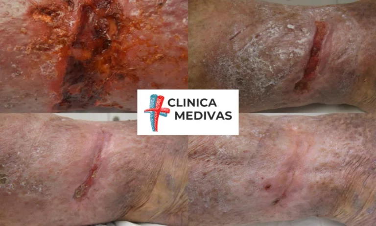 Úlceras venosas y ondas de choque | Clínica Medivás Madrid Imagen informativa de Clínica Medivás Madrid
