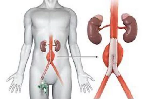 Einstein y el original tratamiento de su aneurisma de aorta