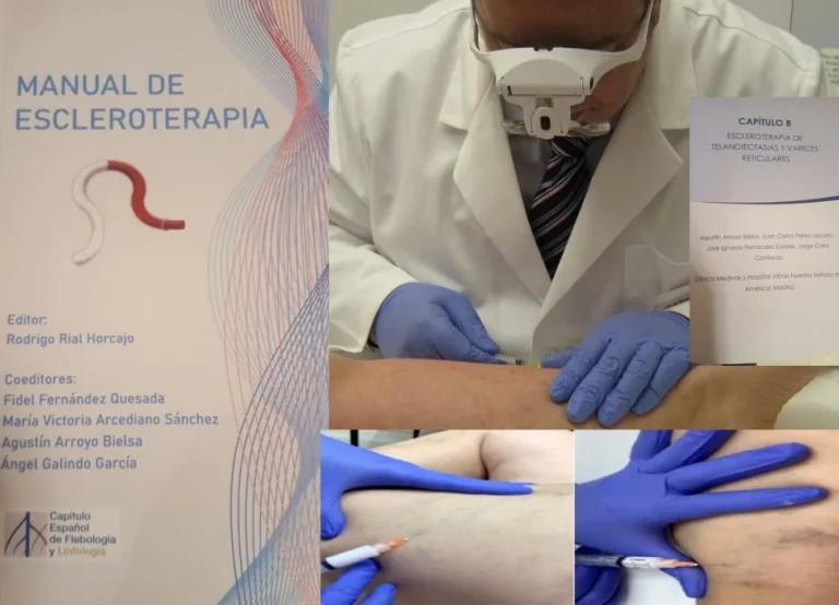 Manual de escleroterapia