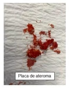 Profundoplastia: una técnica clásica que no pasa de moda
