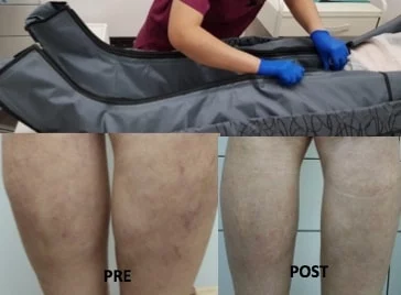 PRESOESCLEROTERAPIA