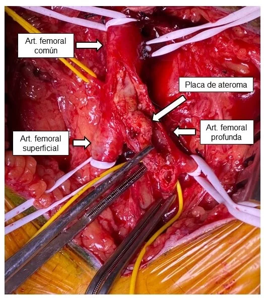 PROFUNDOPLASTIA PRE