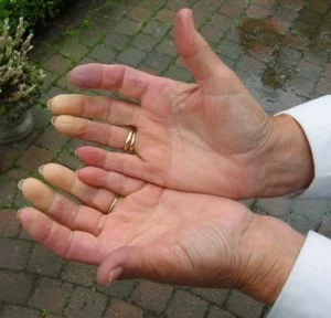 RAYNAUD