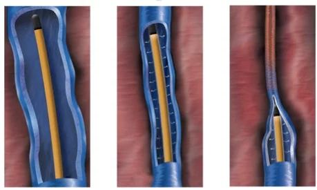 Termoablación en varicose veins: endoláser y radiofrecuencia | Clínica Medivás Madrid TERMOABLACION