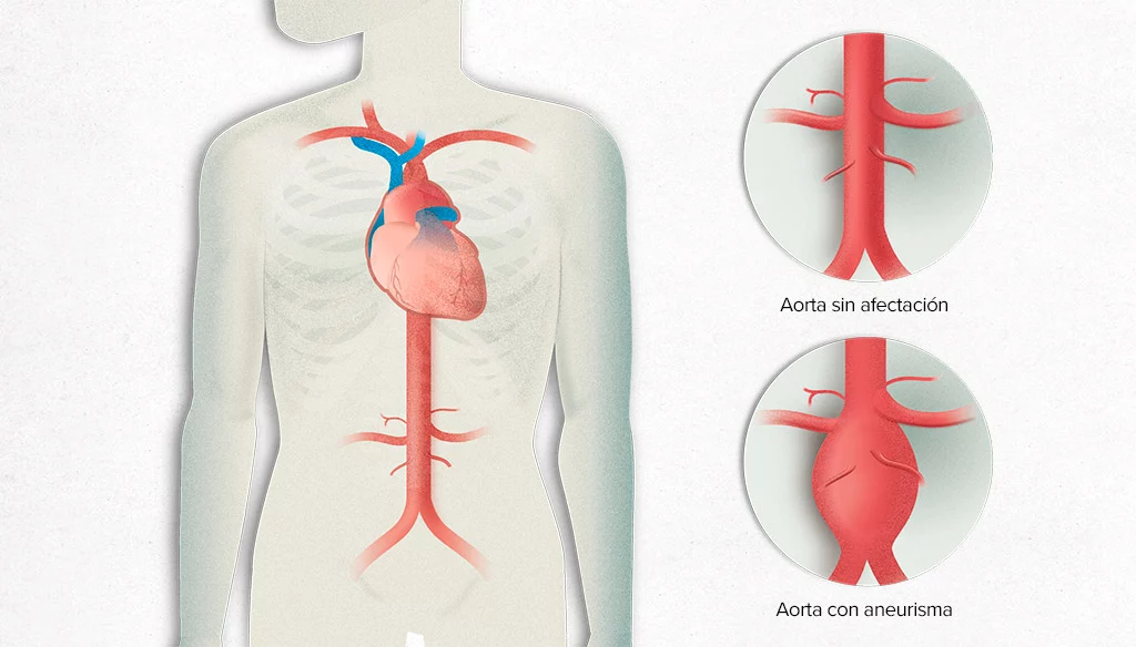 aneurisma de aorta clinica medivas