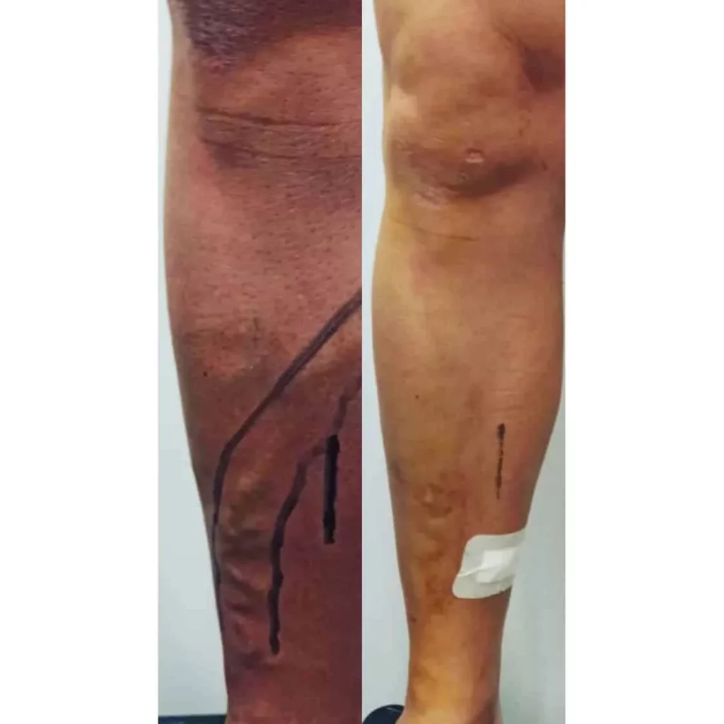 antes y despues VARICES