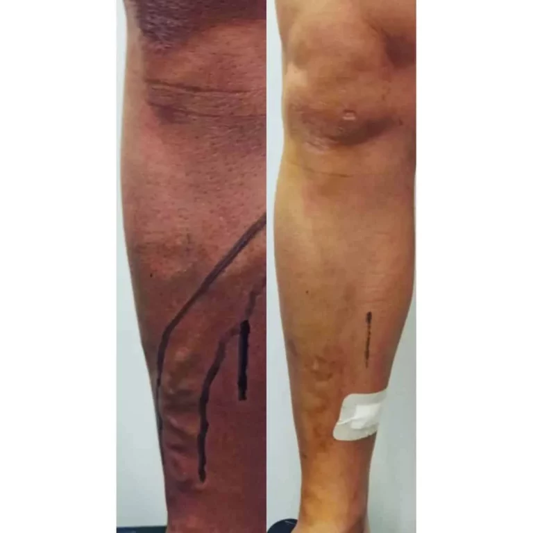 antes y despues VARICES