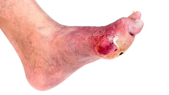 Diabetes related foot infection
