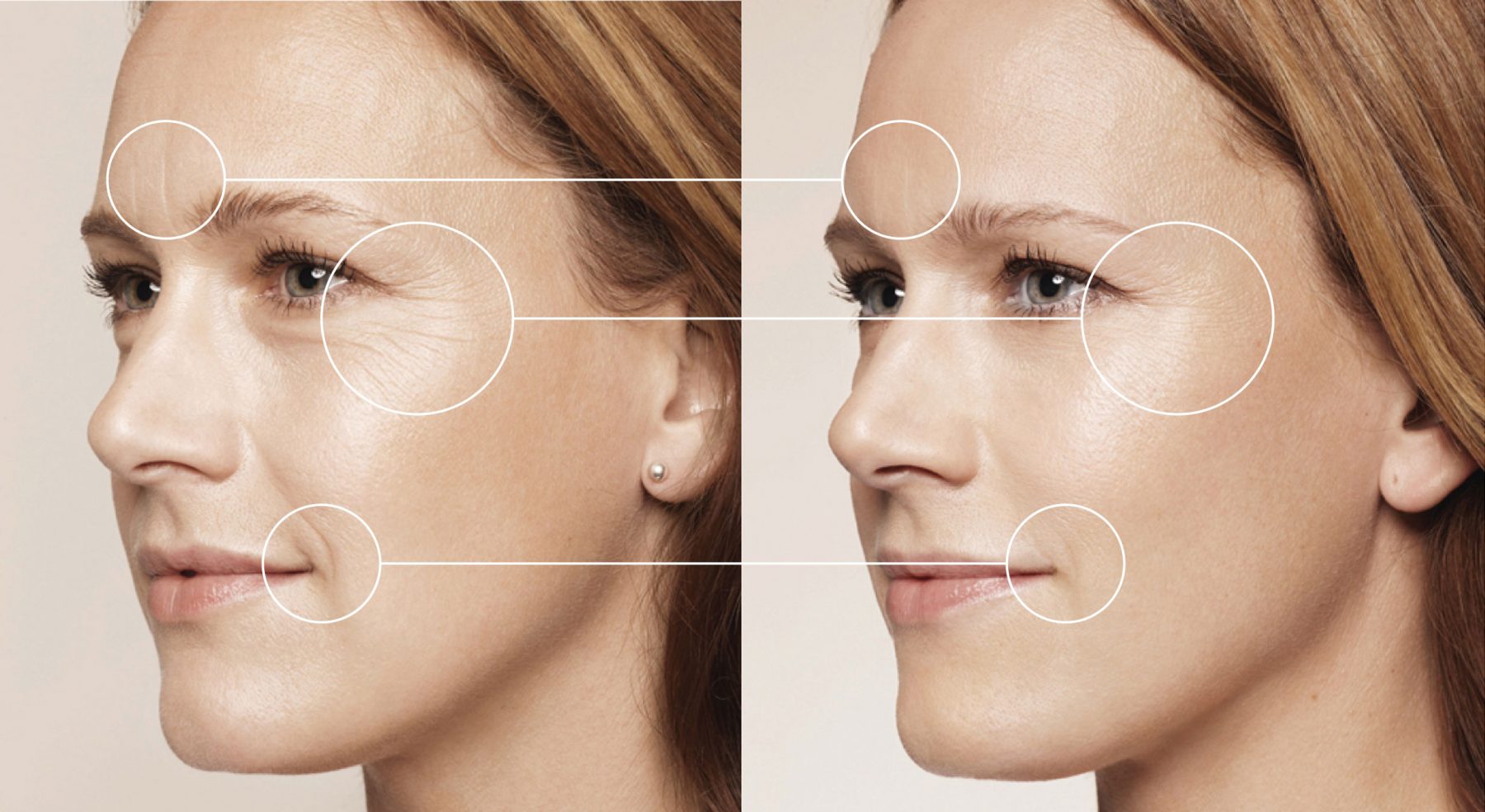 imagen de volumen-facial-clinica-Clínica Medivás-madrid-marbella-scaled.jpg